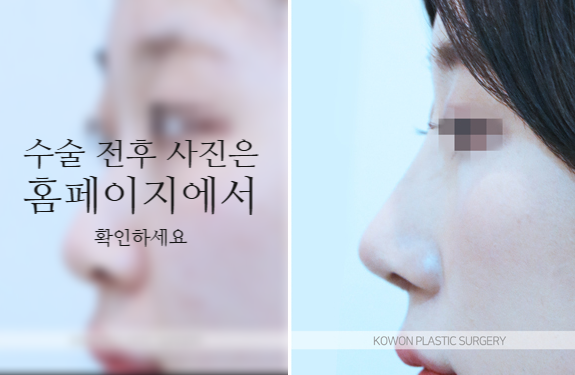 비순각교정 VS 단순 코높임 차이점과 회복에 대하여 사진 8