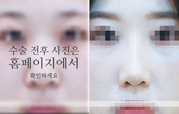 비순각교정 VS 단순 코높임 차이점과 회복에 대하여