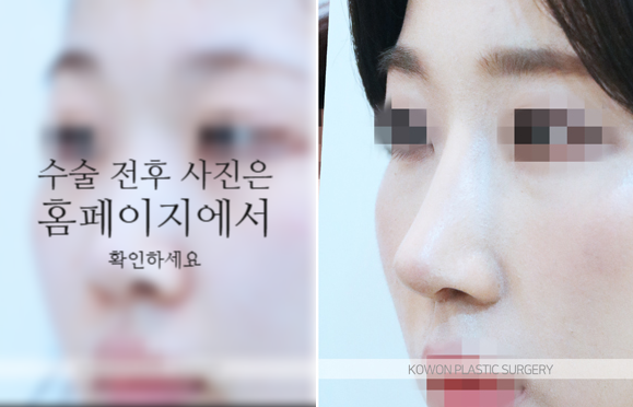 비순각교정 VS 단순 코높임 차이점과 회복에 대하여 사진 5