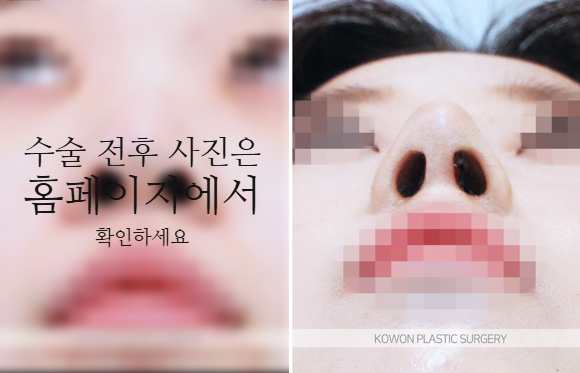 비순각교정 VS 단순 코높임 차이점과 회복에 대하여 사진 6