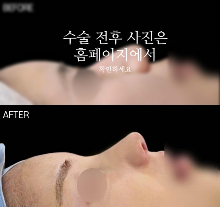 비순각교정 VS 단순 코높임 차이점과 회복에 대하여 사진 2