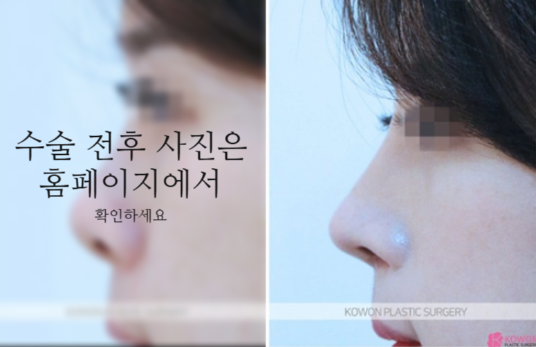 낮은코성형 코끝부터 비순각까지 함께 봐야 하는 3가지 이유 사진 6
