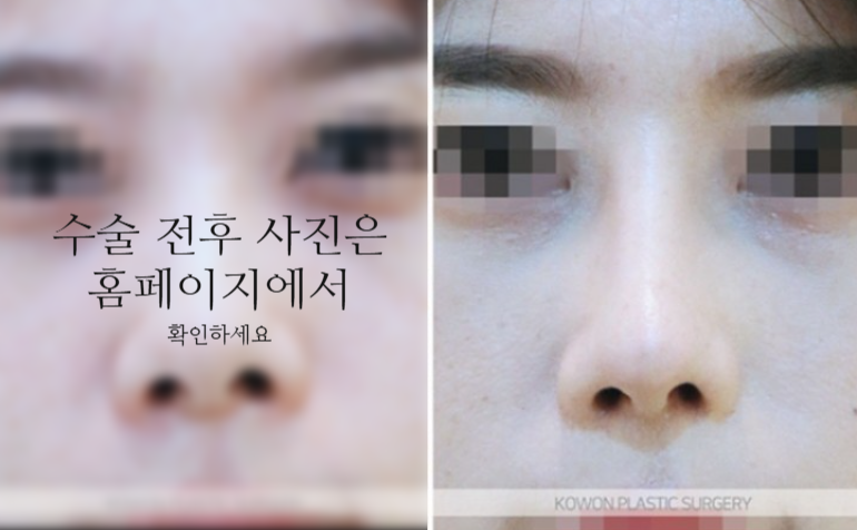 낮은코성형 코끝부터 비순각까지 함께 봐야 하는 3가지 이유 사진 9