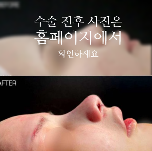 낮은코성형 코끝부터 비순각까지 함께 봐야 하는 3가지 이유 사진 2
