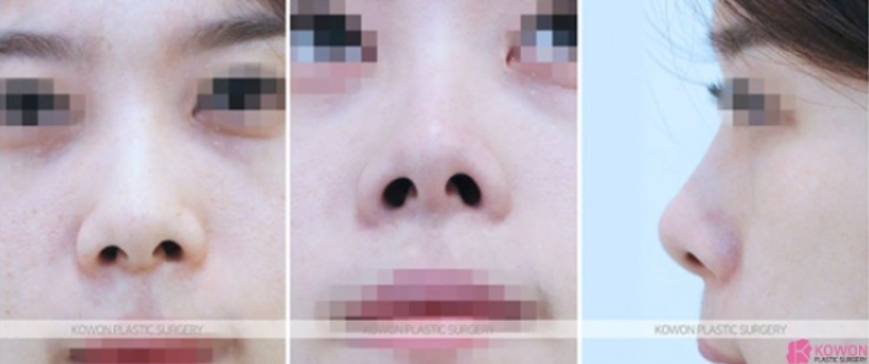 낮은코성형 코끝부터 비순각까지 함께 봐야 하는 3가지 이유 사진 5