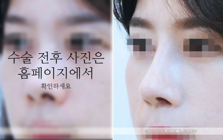 낮은코성형 코끝부터 비순각까지 함께 봐야 하는 3가지 이유 사진 7