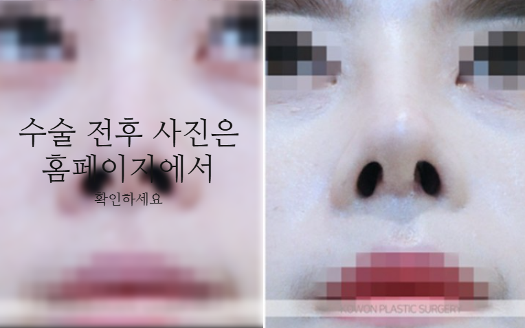 낮은코성형 코끝부터 비순각까지 함께 봐야 하는 3가지 이유 사진 8