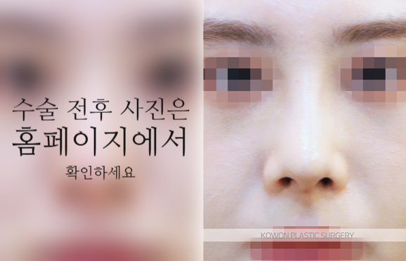 코끝연골재배치 자연스러운 자려한 코를 만드는 3가지 포인트 사진 8