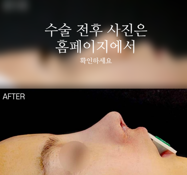 코끝연골재배치 자연스러운 자려한 코를 만드는 3가지 포인트 사진 2