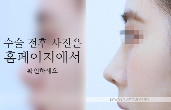 코끝연골재배치 자연스러운 자려한 코를 만드는 3가지 포인트 사진 6