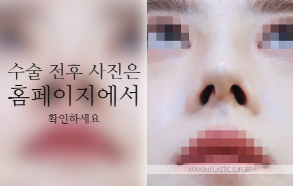 코끝연골재배치 자연스러운 자려한 코를 만드는 3가지 포인트 사진 7