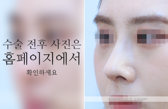 코끝연골재배치 자연스러운 자려한 코를 만드는 3가지 포인트 사진 5