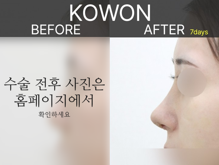 여자매부리코, 복코까지 함께 고려해야 하는 3가지 이유 사진 5