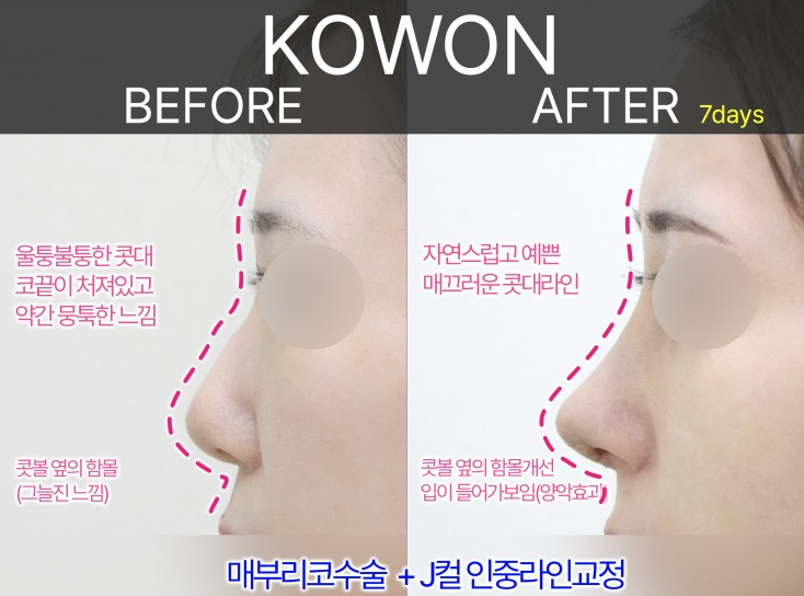 여자매부리코, 복코까지 함께 고려해야 하는 3가지 이유 사진 4