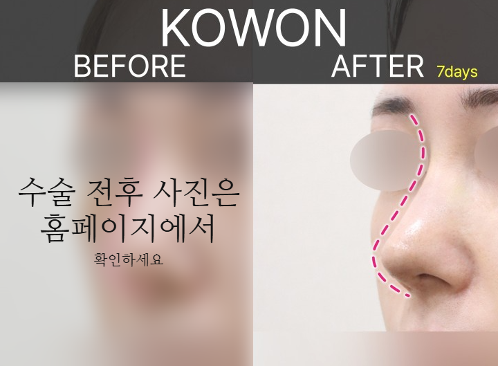 여자매부리코, 복코까지 함께 고려해야 하는 3가지 이유 사진 8