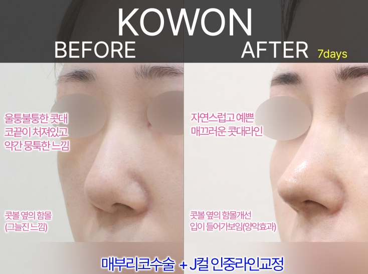 여자매부리코, 복코까지 함께 고려해야 하는 3가지 이유 사진 7
