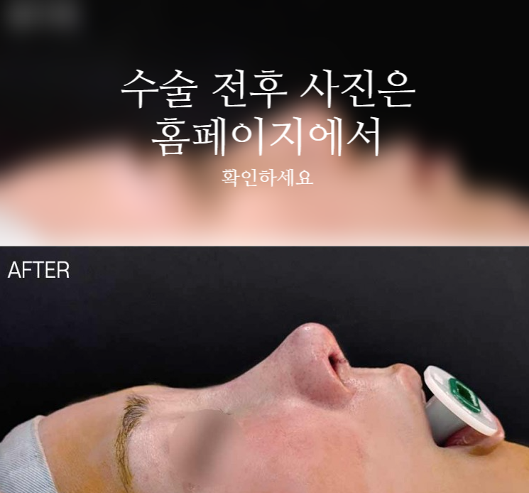 여자매부리코, 복코까지 함께 고려해야 하는 3가지 이유 사진 2