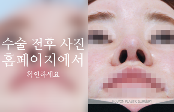 자가늑 코성형으로 코끝 처짐과 구조를 함께 고려해야 하는 이유 사진 6