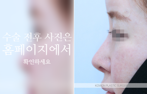 자가늑 코성형으로 코끝 처짐과 구조를 함께 고려해야 하는 이유 사진 8