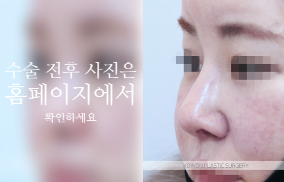 자가늑 코성형으로 코끝 처짐과 구조를 함께 고려해야 하는 이유 사진 7