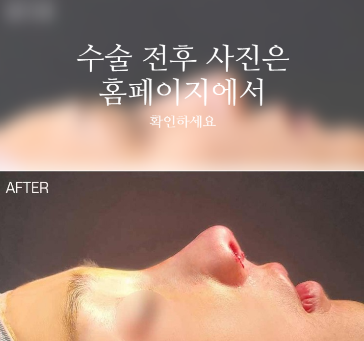 자가늑 코성형으로 코끝 처짐과 구조를 함께 고려해야 하는 이유 사진 2