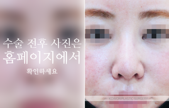 자가늑 코성형으로 코끝 처짐과 구조를 함께 고려해야 하는 이유 사진 5