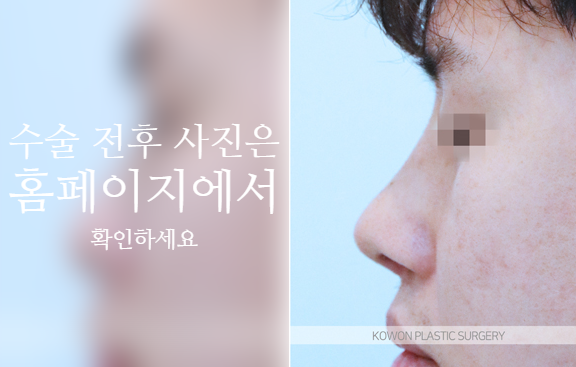 남자복코수술 매부리코와 콧볼을 함께 교정해야 자연스러운 이유 사진 9
