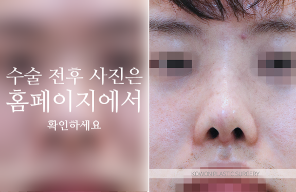 남자복코수술 매부리코와 콧볼을 함께 교정해야 자연스러운 이유 사진 8