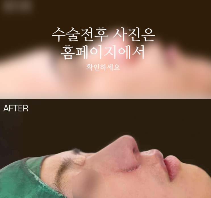 남자복코수술 매부리코와 콧볼을 함께 교정해야 자연스러운 이유 사진 2