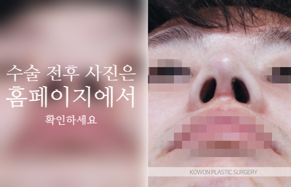 남자복코수술 매부리코와 콧볼을 함께 교정해야 자연스러운 이유 사진 7