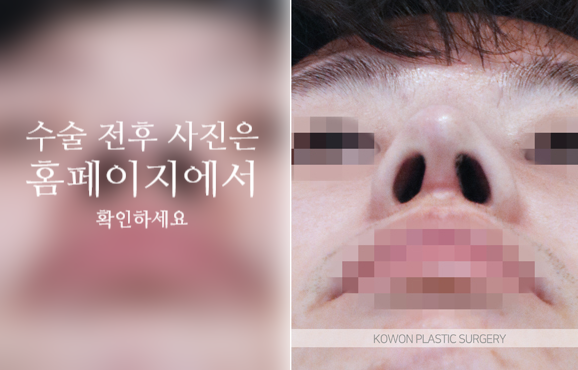 남자복코수술 매부리코와 콧볼을 함께 교정해야 자연스러운 이유 사진 4