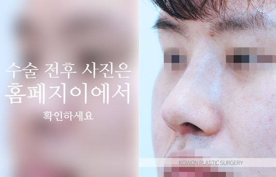 남자복코수술 매부리코와 콧볼을 함께 교정해야 자연스러운 이유 사진 6