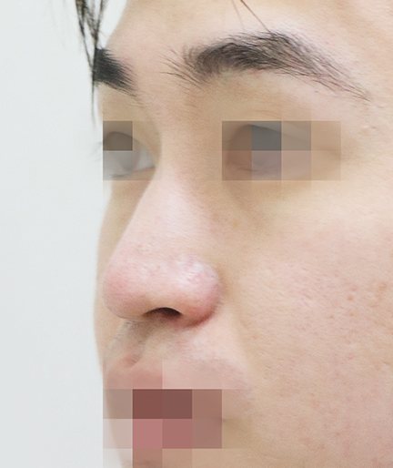 남자코성형전후 매부리코 수술에서 콧대와 코끝을 함께 보는 이유 사진 4