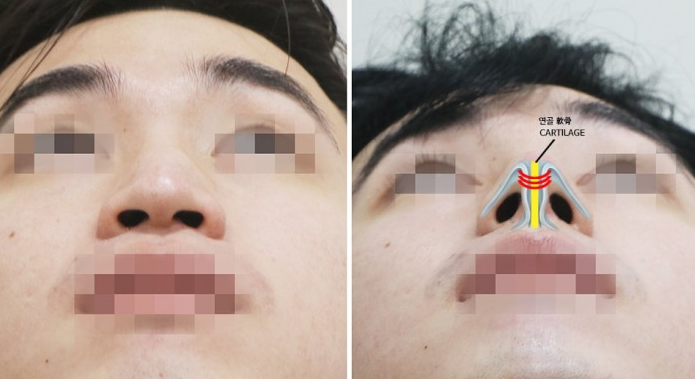 남자코성형전후 매부리코 수술에서 콧대와 코끝을 함께 보는 이유