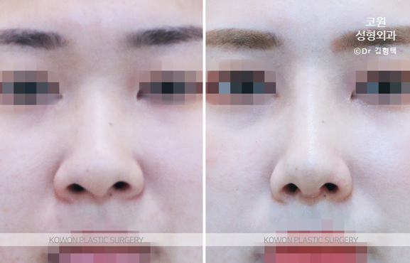 코끝 연골묶기 전후 단순히 모으는 변화보다 중요한 구조적 균형 사진 4