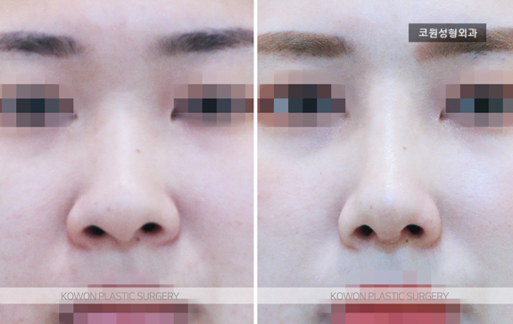 코끝연골재배치로 얼굴 중심 입체감을 살린 자려한 코라인 사례