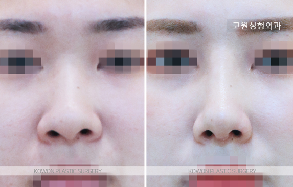 복코수술전후 코끝만 줄이기보다 미간과 콧대 흐름을 함께 보는 이유 사진 3