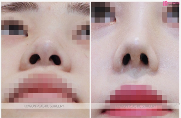 미간부터 코끝까지 매끄럽게! 입체감을 살리는 코원성형외과의낮은코수술 노하우 사진 4