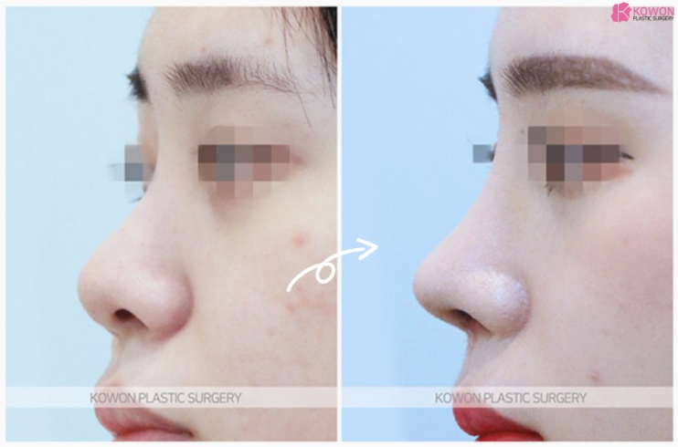 미간부터 코끝까지 매끄럽게! 입체감을 살리는 코원성형외과의낮은코수술 노하우 사진 3
