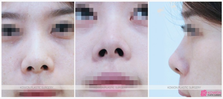 자연스러운 입체감을 완성하는 들창코 수술, 만족도를 높이는 코원성형외과의 노하우 사진 3