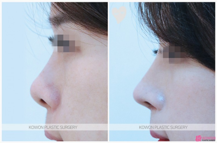 자연스러운 입체감을 완성하는 들창코 수술, 만족도를 높이는 코원성형외과의 노하우
