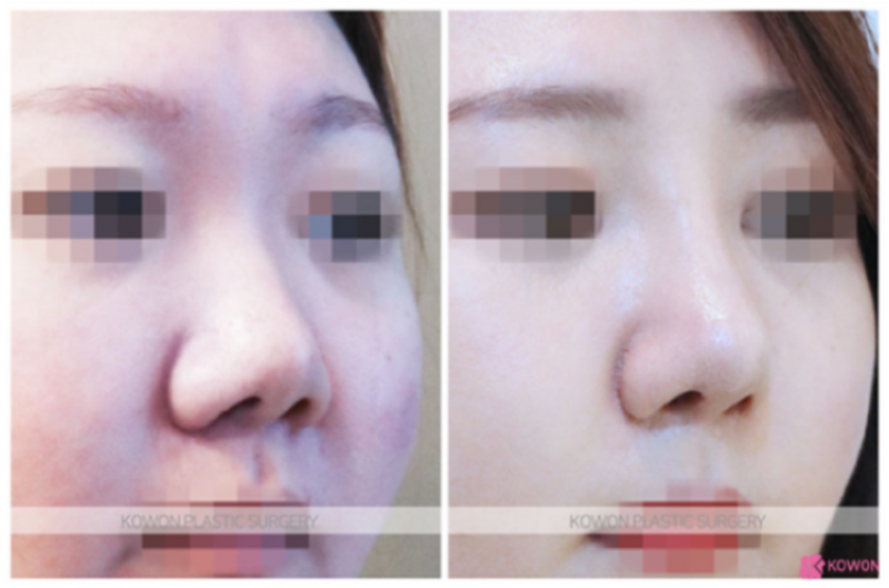 콧날개수술, 단순히 콧볼만 줄이는 수술일까요? | 코원성형외과