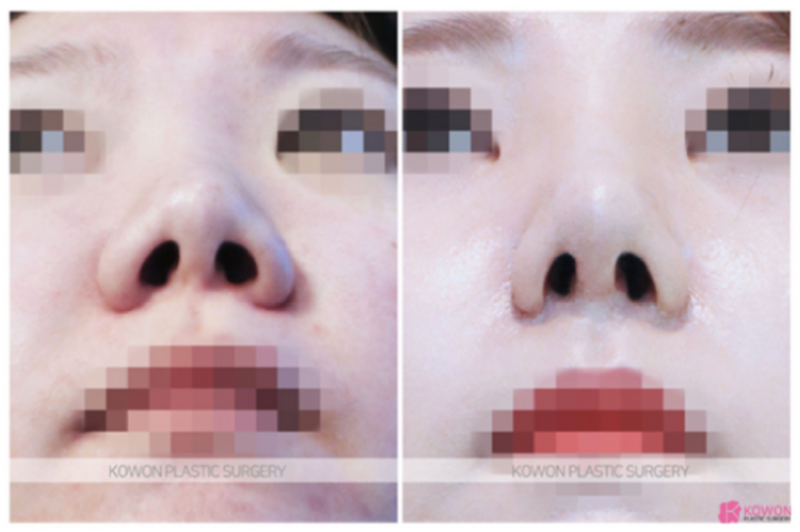 콧날개수술, 단순히 콧볼만 줄이는 수술일까요? | 코원성형외과 사진 3