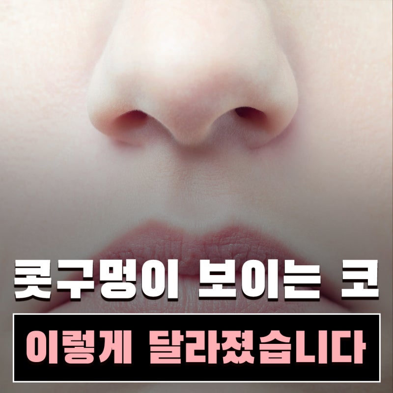 콧날개수술, 단순히 콧볼만 줄이는 수술일까요? | 코원성형외과