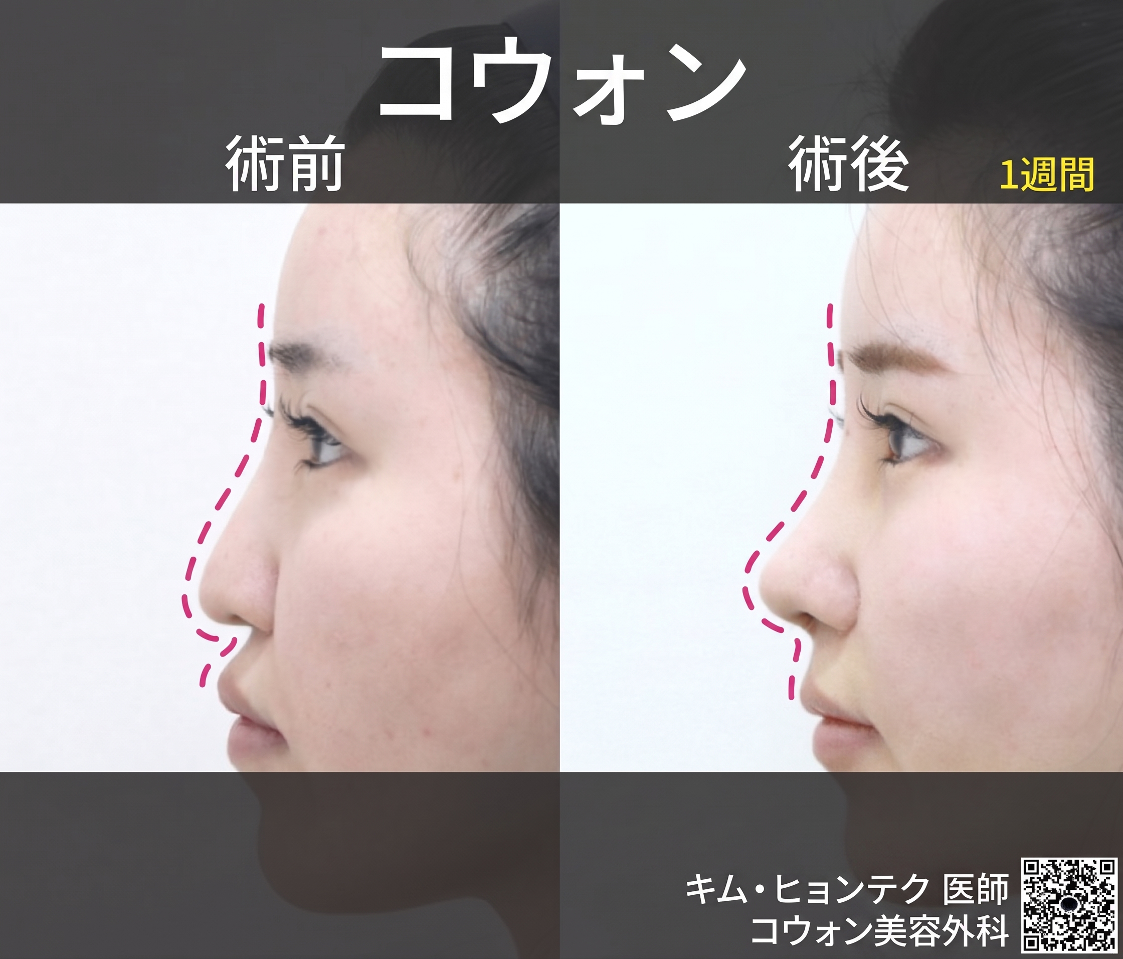 笑うと下がる鼻先、鼻先の垂れ下がり再手術で若々しいラインを完成｜コウォン整形外科 사진 3