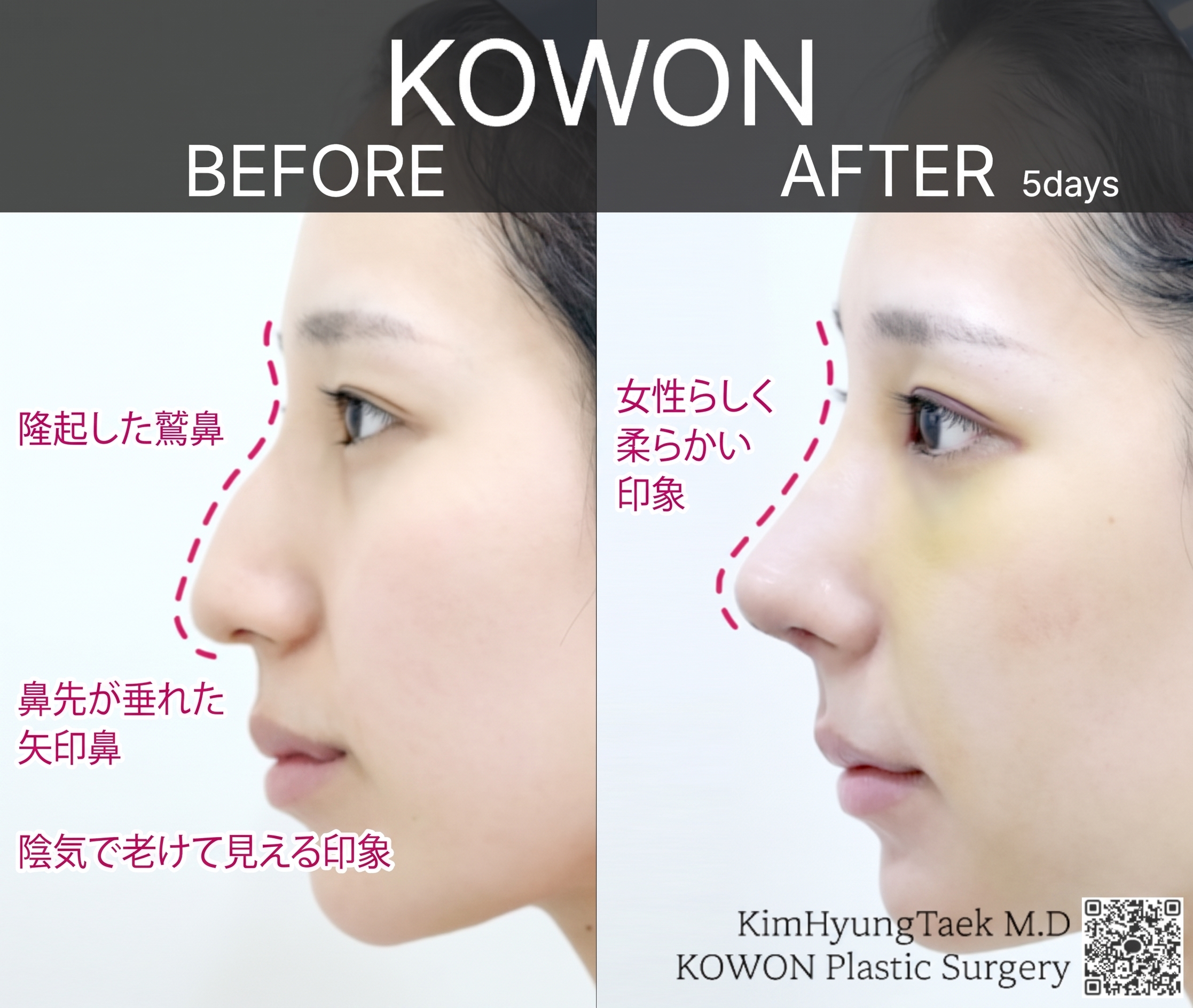 段鼻矯正で生まれ変わった団子鼻、KOWON整形外科の鼻整形症例から見るビフォーアフターの変化 사진 3