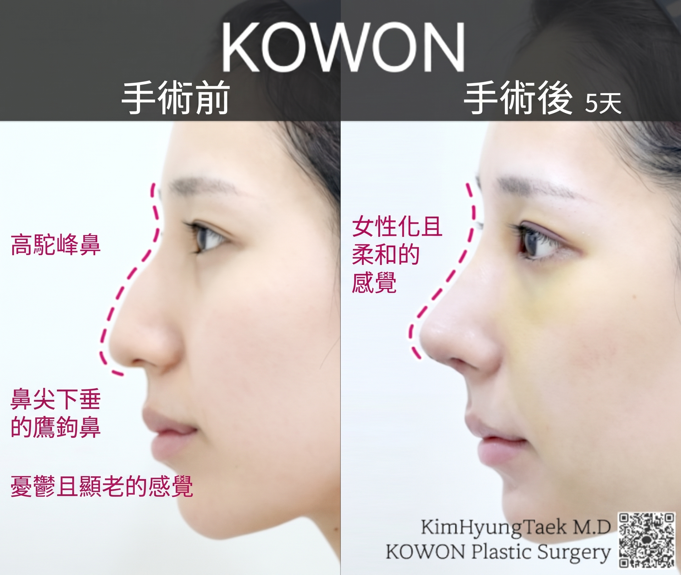 駝峰鼻矯正改善蒜頭鼻，從 Kowon 整形外科隆鼻案例看術前後變化 사진 3