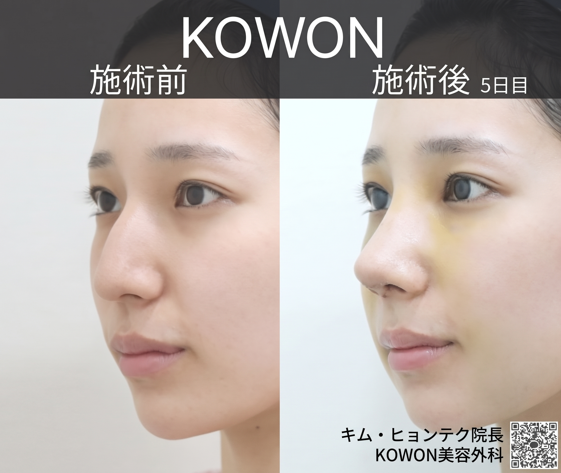 段鼻矯正で生まれ変わった団子鼻、KOWON整形外科の鼻整形症例から見るビフォーアフターの変化 사진 4