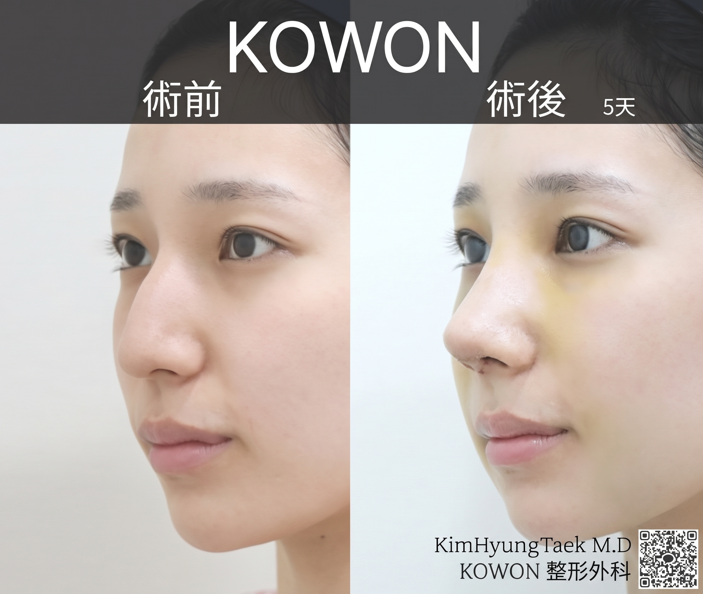 駝峰鼻矯正改善蒜頭鼻，從 Kowon 整形外科隆鼻案例看術前後變化 사진 4