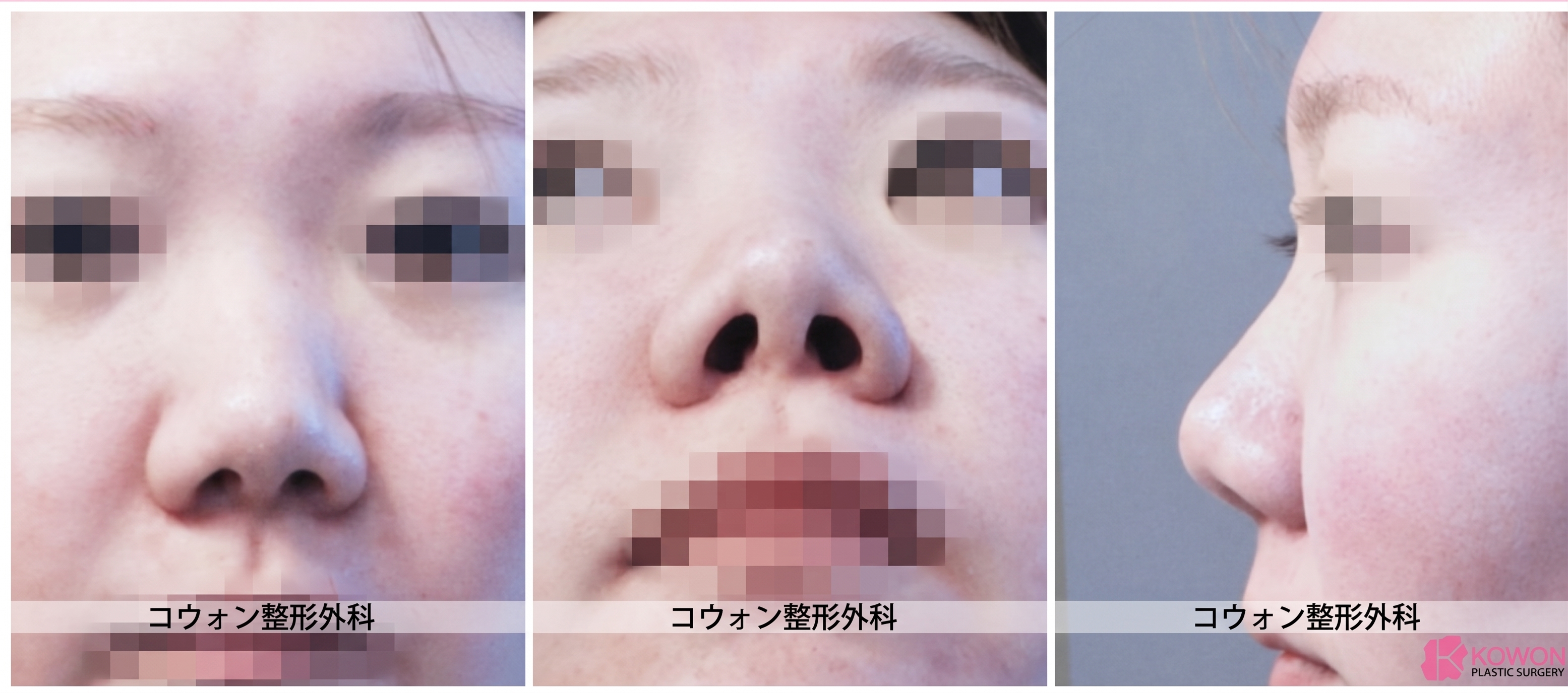 小さい鼻の整形、短い鼻と丸い鼻先を自然に改善したコウォン整形外科の症例 사진 3